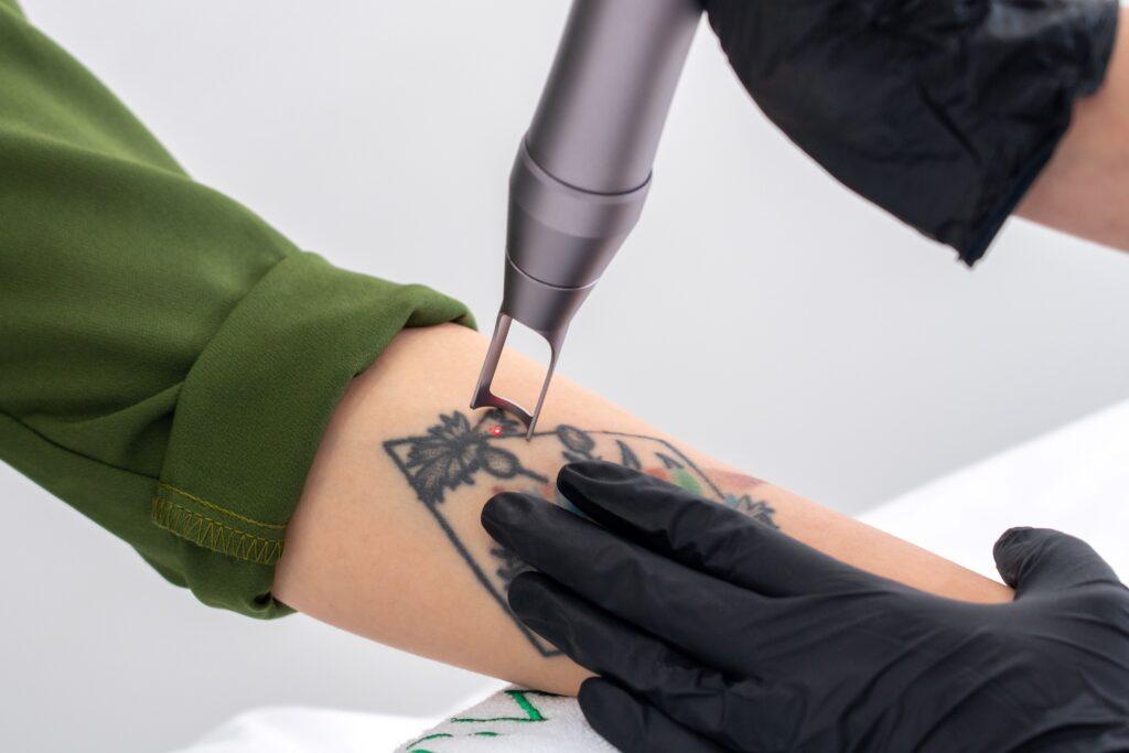 Tattooentfernung Essen mit der Lasermethode